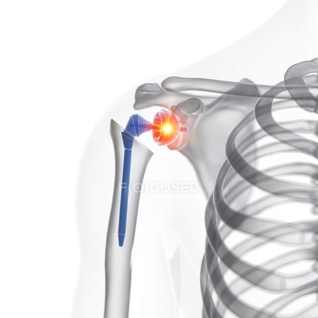Ilustración del implante de reemplazo de hombro con dolor sobre fondo blanco
. - foto de stock