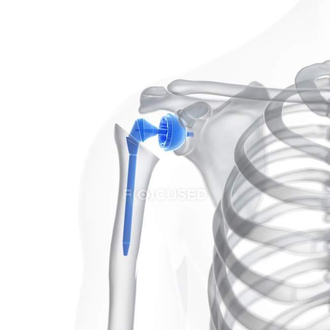 Ilustración del implante de reemplazo de hombro sobre fondo blanco . - foto de stock