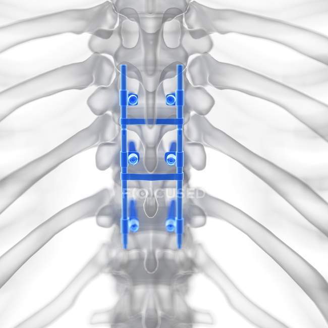 Illustrazione della fusione spinale nello scheletro umano . — Foto stock