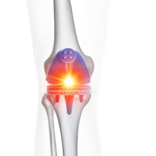 Ilustración del implante de reemplazo de rodilla con dolor sobre fondo blanco . - foto de stock