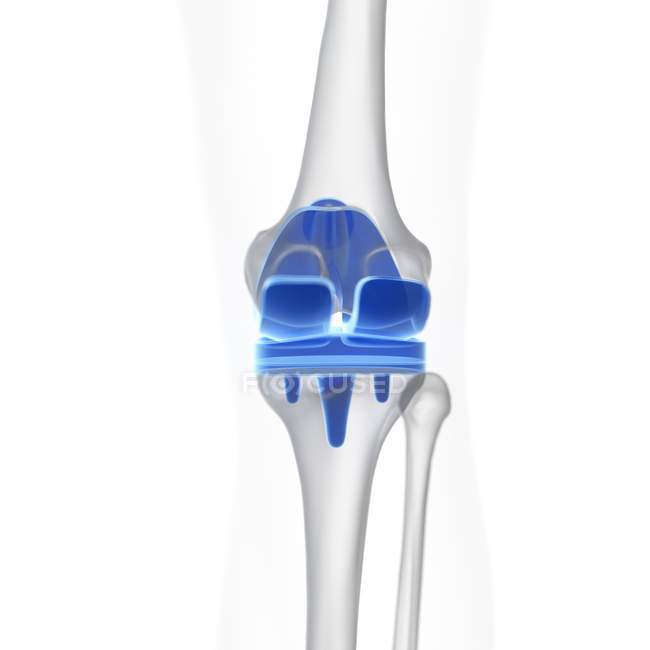 Ilustración del implante de reemplazo de rodilla sobre fondo blanco . - foto de stock
