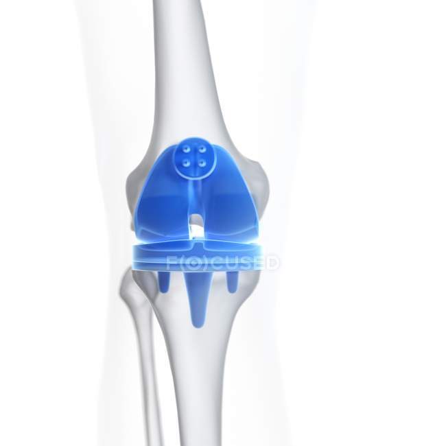 Ilustración del implante de reemplazo de rodilla sobre fondo blanco . - foto de stock