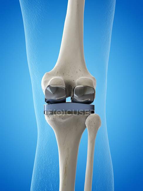 Ilustración del implante de reemplazo de rodilla sobre fondo azul . - foto de stock