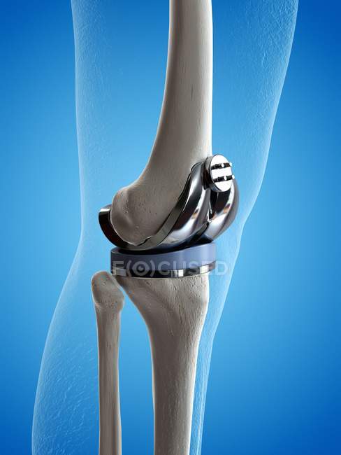 Ілюстрація імплантату заміни коліна на синьому фоні . — стокове фото