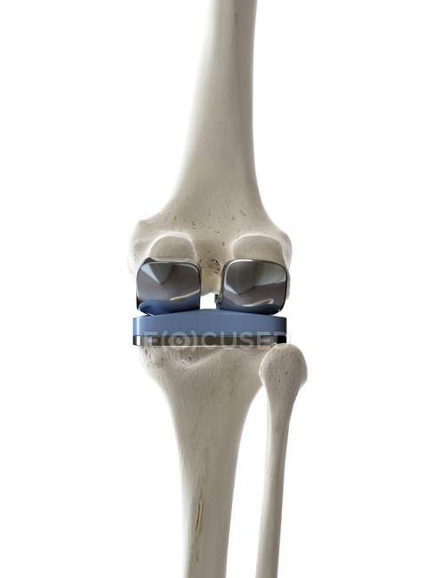 Ілюстрація протезу для заміни коліна на білому тлі . — стокове фото