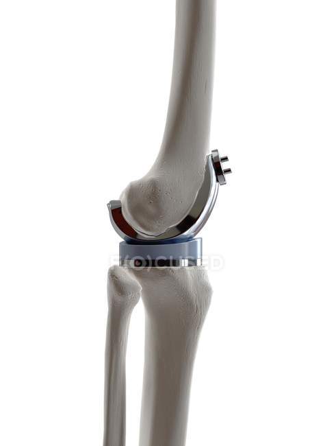 Ilustração da prótese de substituição do joelho sobre fundo branco . — Fotografia de Stock