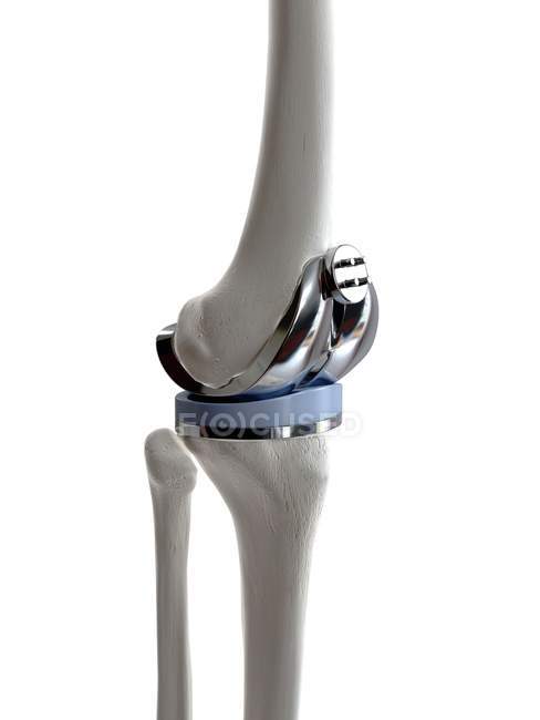 Ilustración de prótesis de reemplazo de rodilla sobre fondo blanco . - foto de stock