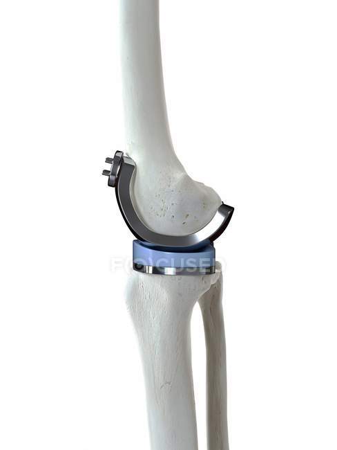 Ilustração da prótese de substituição do joelho sobre fundo branco . — Fotografia de Stock