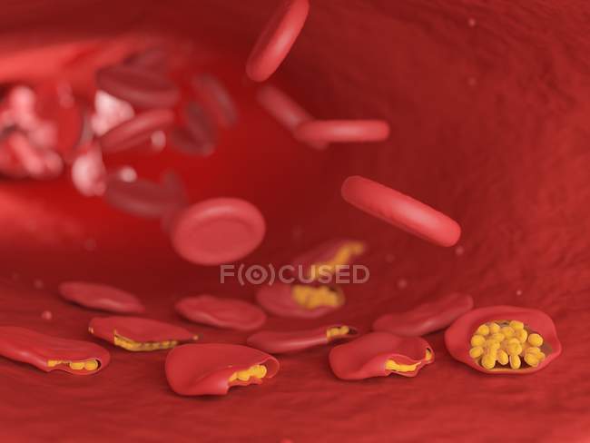 Illustration de cellules sanguines infectées par le paludisme . — Photo de stock