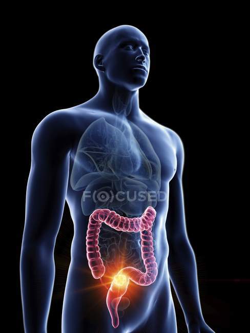 Ilustración de silueta azul transparente del cuerpo masculino con tumor coloreado del colon . - foto de stock
