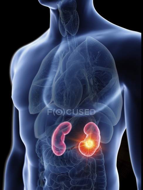 Ilustração da silhueta azul transparente do corpo masculino com tumores renais coloridos
. — Fotografia de Stock