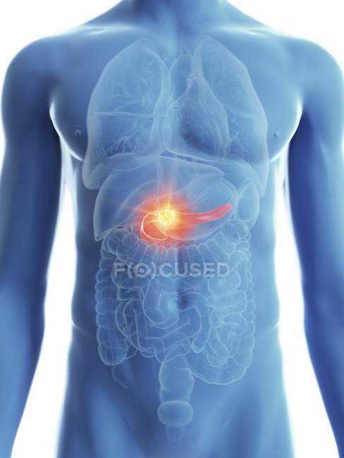 Ilustración de silueta azul transparente del cuerpo masculino con cáncer de páncreas coloreado . - foto de stock