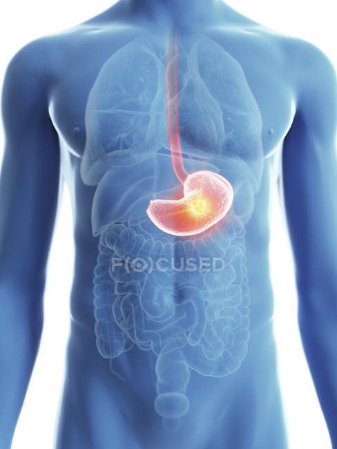 Ilustración de silueta azul transparente del cuerpo masculino con cáncer de estómago coloreado
. - foto de stock