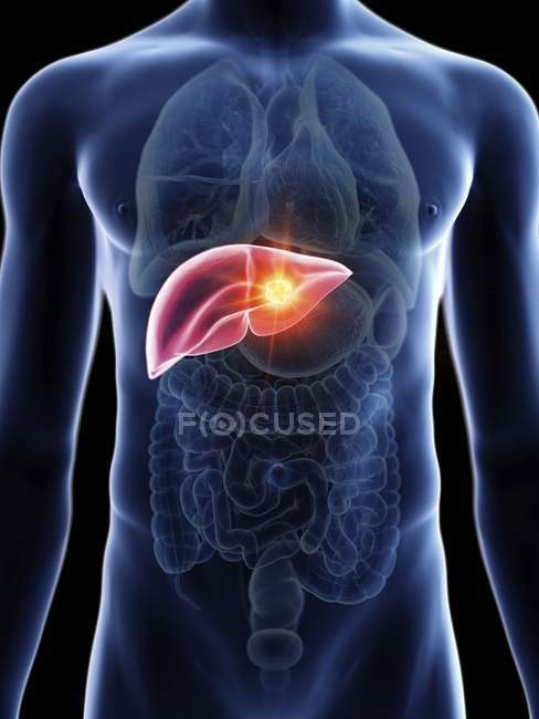 Illustration of transparent blue silhouette of male body with colored liver cancer. — Stock Photo
