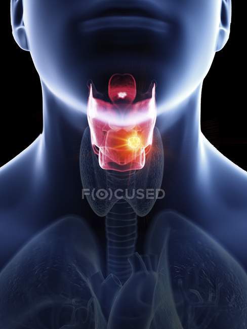 Illustration du cancer du larynx dans la silhouette du corps masculin, gros plan . — Photo de stock