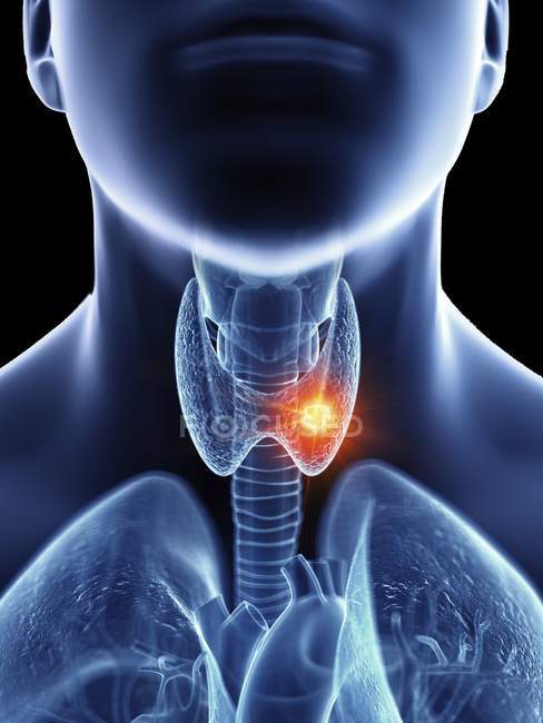 Ilustração do câncer de garganta na silhueta do corpo masculino, close-up . — Fotografia de Stock