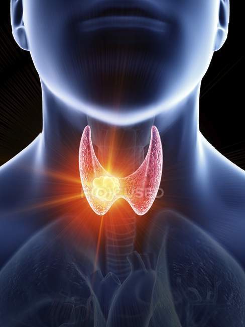 Ilustración de cáncer de glándula tiroides en silueta corporal masculina, primer plano . - foto de stock