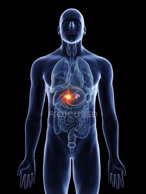 Ilustración del cáncer de glándulas suprarrenales en la silueta corporal masculina . - foto de stock