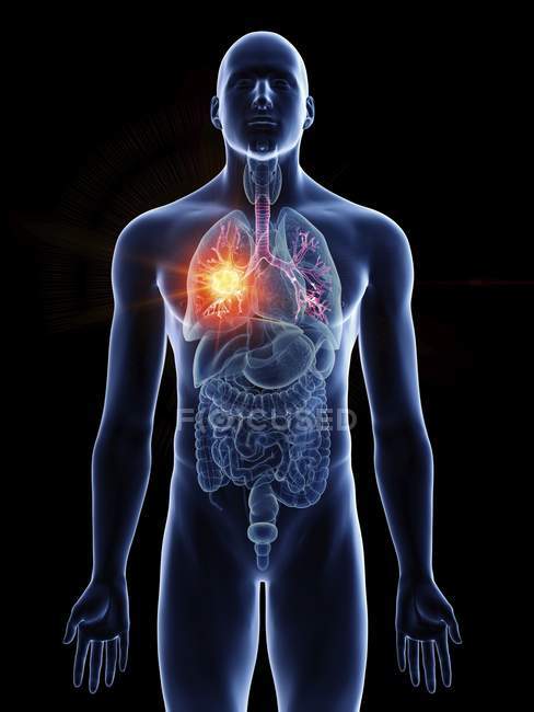Ілюстрація бронхів раку в чоловічому організмі силует на чорному фоні. — стокове фото