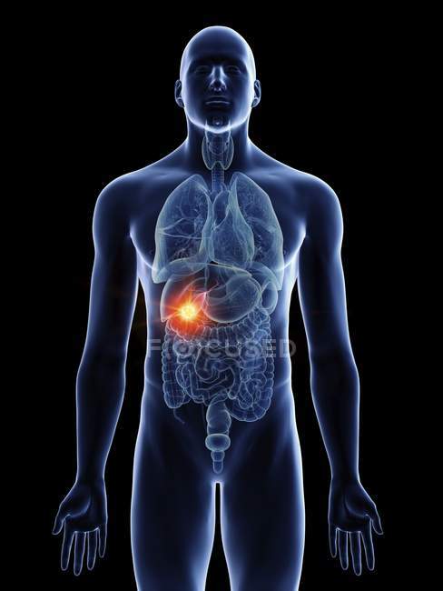 Ilustración de cáncer de vesícula biliar en silueta corporal masculina sobre fondo negro . - foto de stock