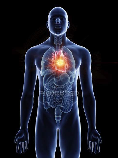 Illustrazione del tumore al cuore nella silhouette del corpo maschile su sfondo nero . — Foto stock