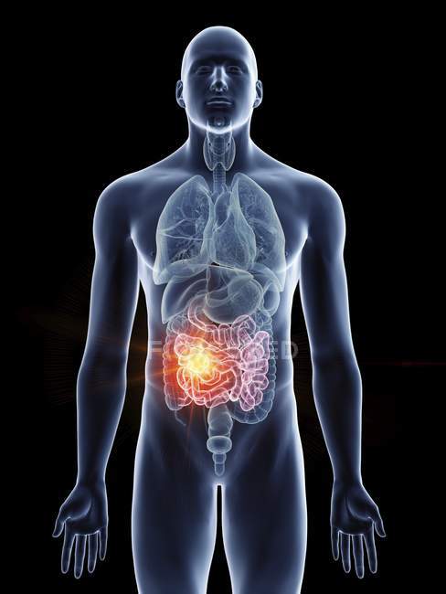 Ilustración de cáncer de intestino delgado en silueta corporal masculina sobre fondo negro
. - foto de stock