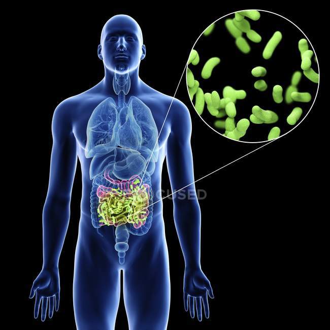 Ilustración del intestino delgado y primer plano de la infección en la silueta corporal masculina sobre fondo negro . - foto de stock