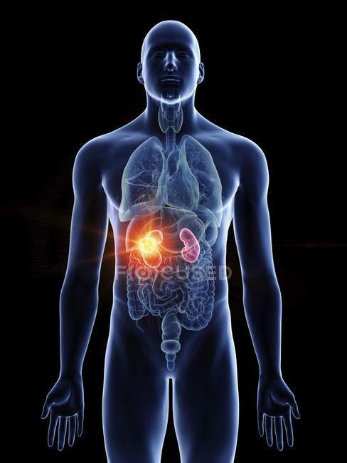Ilustração do câncer de rim na silhueta do corpo masculino em fundo preto . — Fotografia de Stock