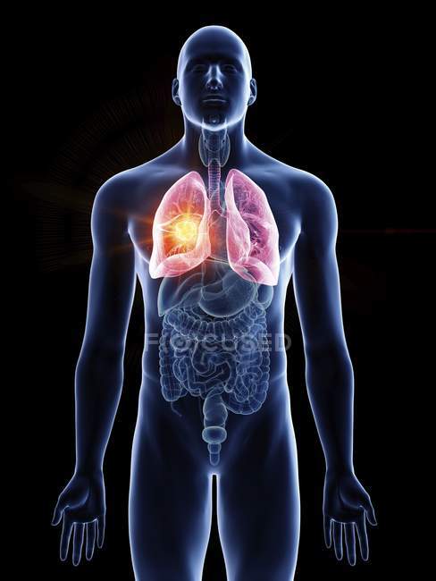 Ilustración de cáncer de pulmón en silueta corporal masculina sobre fondo negro
. - foto de stock