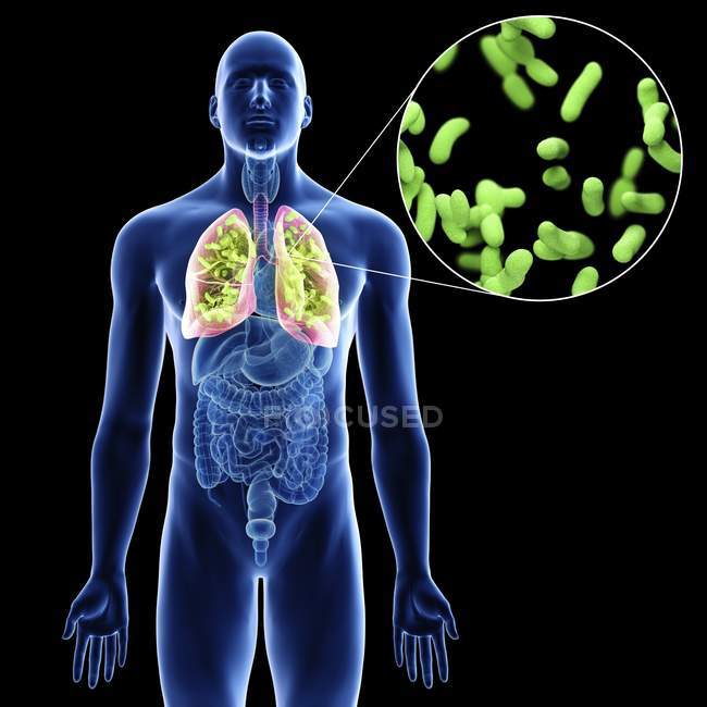 Ilustração dos pulmões com close-up com infecção na silhueta do corpo masculino em fundo preto . — Fotografia de Stock