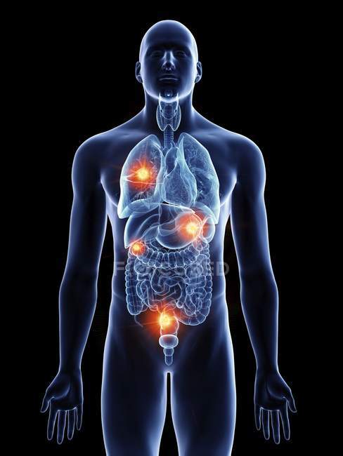 Illustration médicale des métastases des organes dans le corps humain
. — Photo de stock