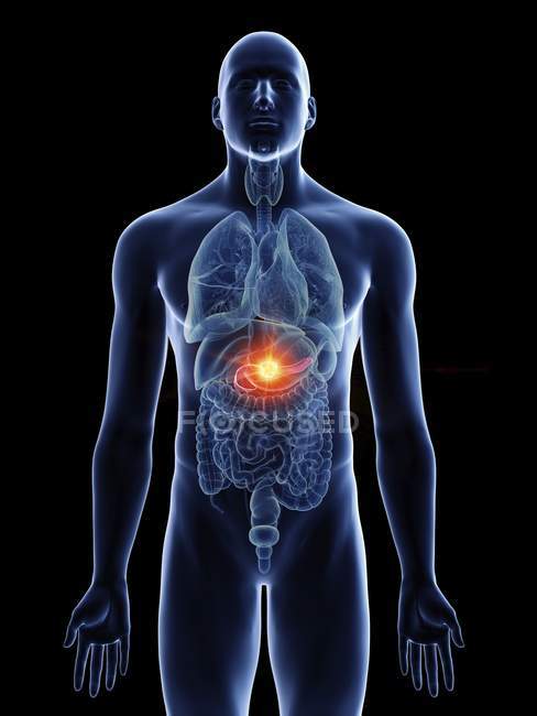 Ilustración de cáncer de páncreas en silueta corporal masculina sobre fondo negro . - foto de stock