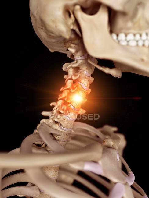 Illustration du squelette humain avec cou douloureux . — Photo de stock