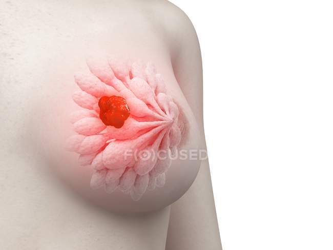 Ilustración médica del tumor de mama en el cuerpo humano . - foto de stock