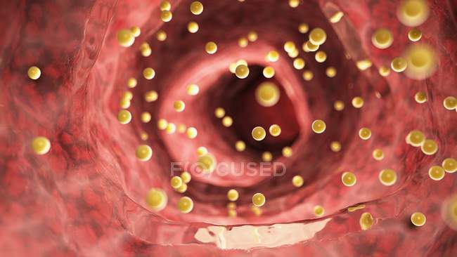 Ilustración de la inflamación del colon causada por el gluten . - foto de stock