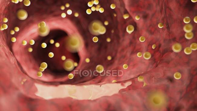 Ilustración de la inflamación del colon causada por el gluten . - foto de stock