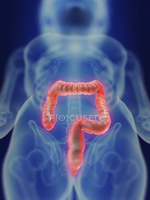 Ilustración de la silueta humana con colon inflamado . - foto de stock