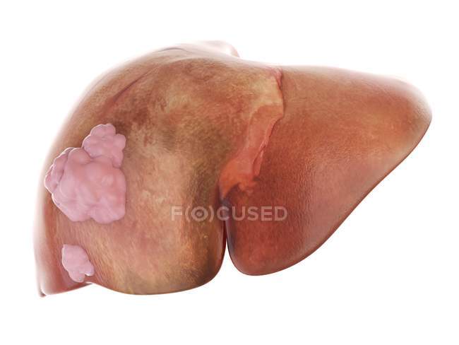 3D gerenderte Darstellung von Leberkrebs auf weißem Hintergrund. — Stockfoto