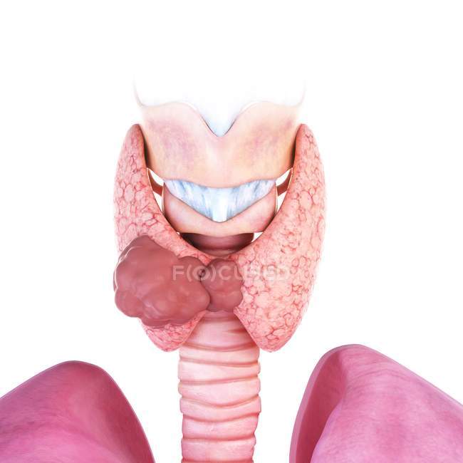 3d renderizado ilustración de cáncer de glándula tiroides . - foto de stock