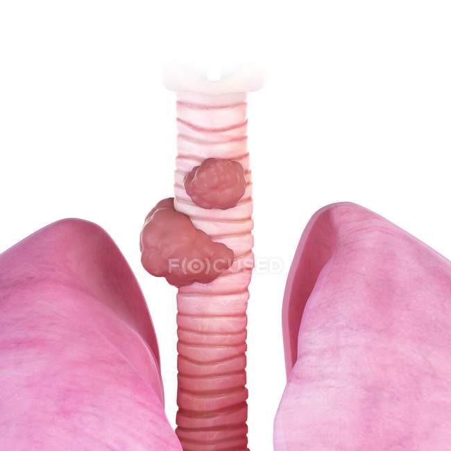 3d rendered illustration of trachea cancer on white background. — Stock Photo