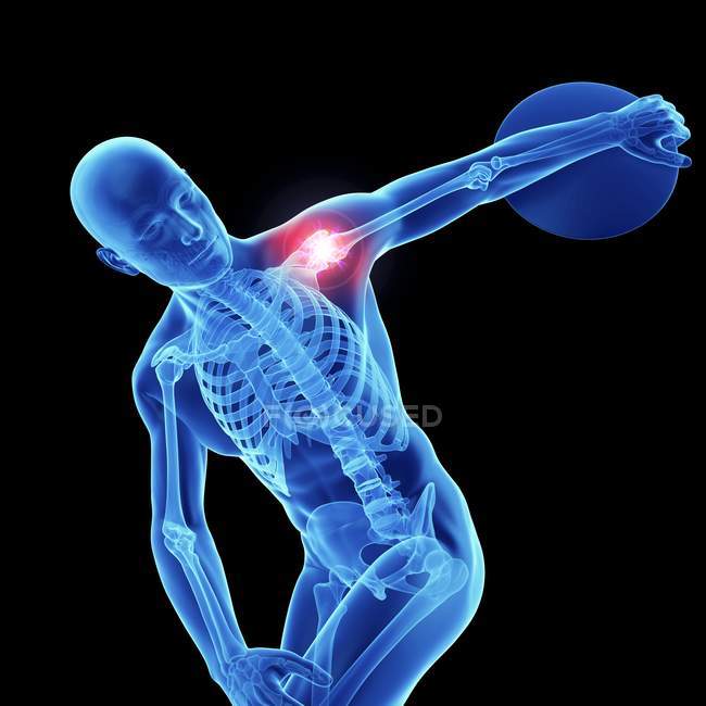 3D gerenderte Darstellung eines männlichen Athleten mit Bandscheibe und schmerzhafter Schulter. — Stockfoto