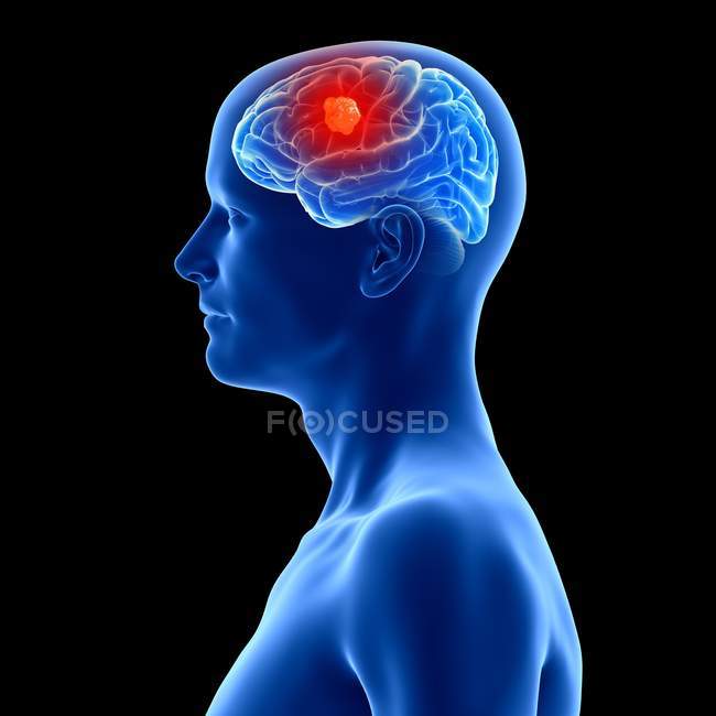 Illustration 3D de tumeur cérébrale dans la silhouette humaine . — Photo de stock