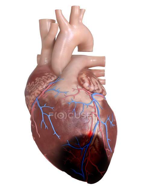 3d renderizado ilustración de ataque al corazón sobre fondo blanco . - foto de stock