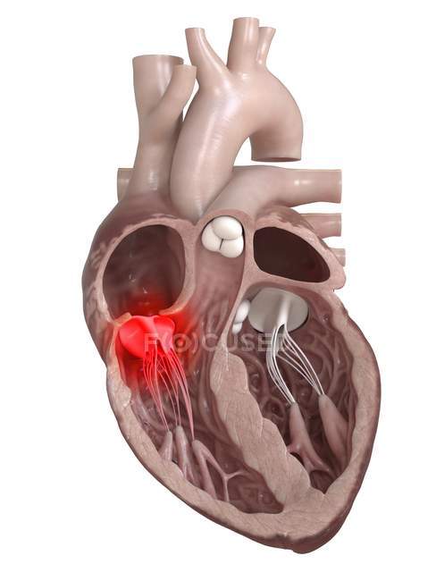 3d renderizado ilustración de la válvula cardíaca enferma sobre fondo blanco
. - foto de stock