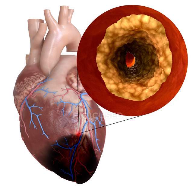 3D gerenderte Illustration des Herzinfarkts auf weißem Hintergrund. — Stockfoto