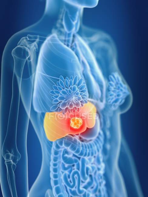 3D ілюстрація кольорового жіночого раку печінки в силуеті тіла . — стокове фото