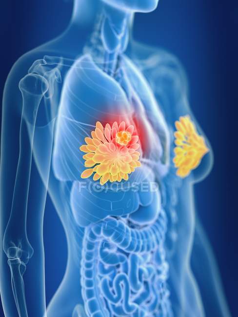 Illustration en 3D des glandes mammaires féminines colorées cancer dans la silhouette du corps
. — Photo de stock