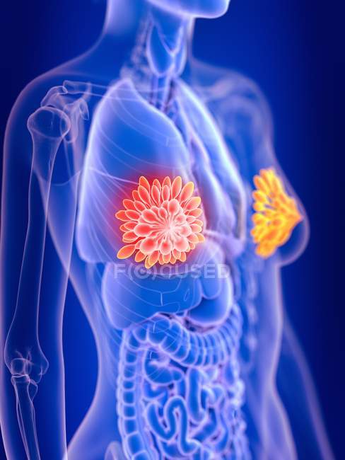 3d renderizado ilustración de color de las glándulas mamarias femeninas cáncer en silueta corporal . - foto de stock