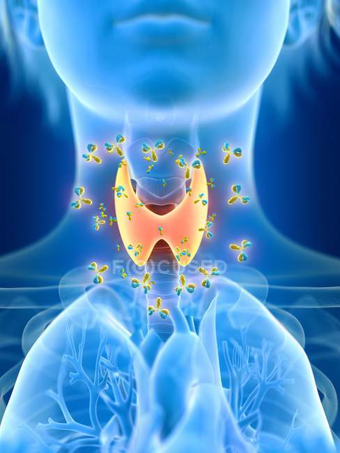 3D gerenderte Illustration der farbigen weiblichen Schilddrüse, die von Antikörpern angegriffen wird. — Stockfoto