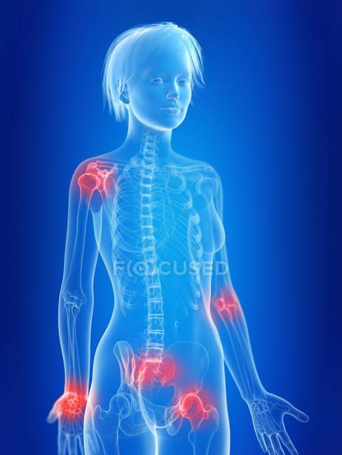 3d rendered illustration of highlighted female painful joints. — Stock Photo